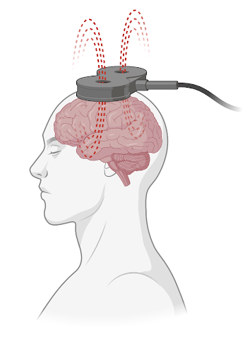 A diagram of transcranial magnetic stimulation